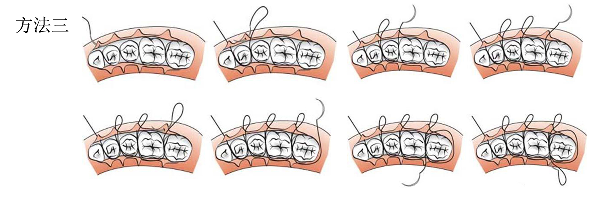 醫(yī)用手術(shù)縫合線縫合方法.jpg
